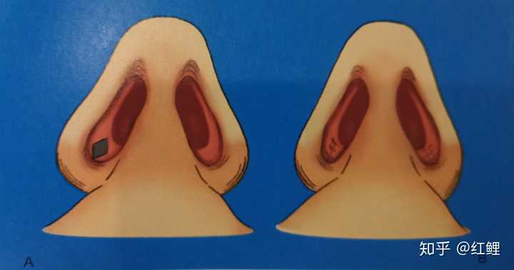 做鼻综合是什么体验?