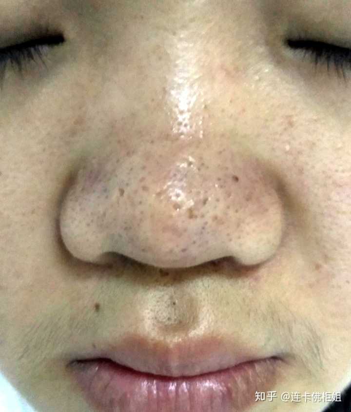 鼻子上有好多黑头还红红的脸颊两边也毛孔很大怎么办