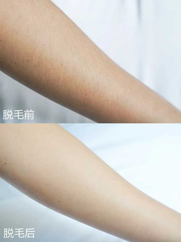 家用激光脱毛仪哪个牌子比较好 睡不醒少女的回答 知乎