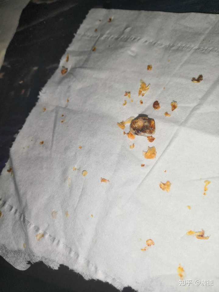 耳屎能大到什么程度