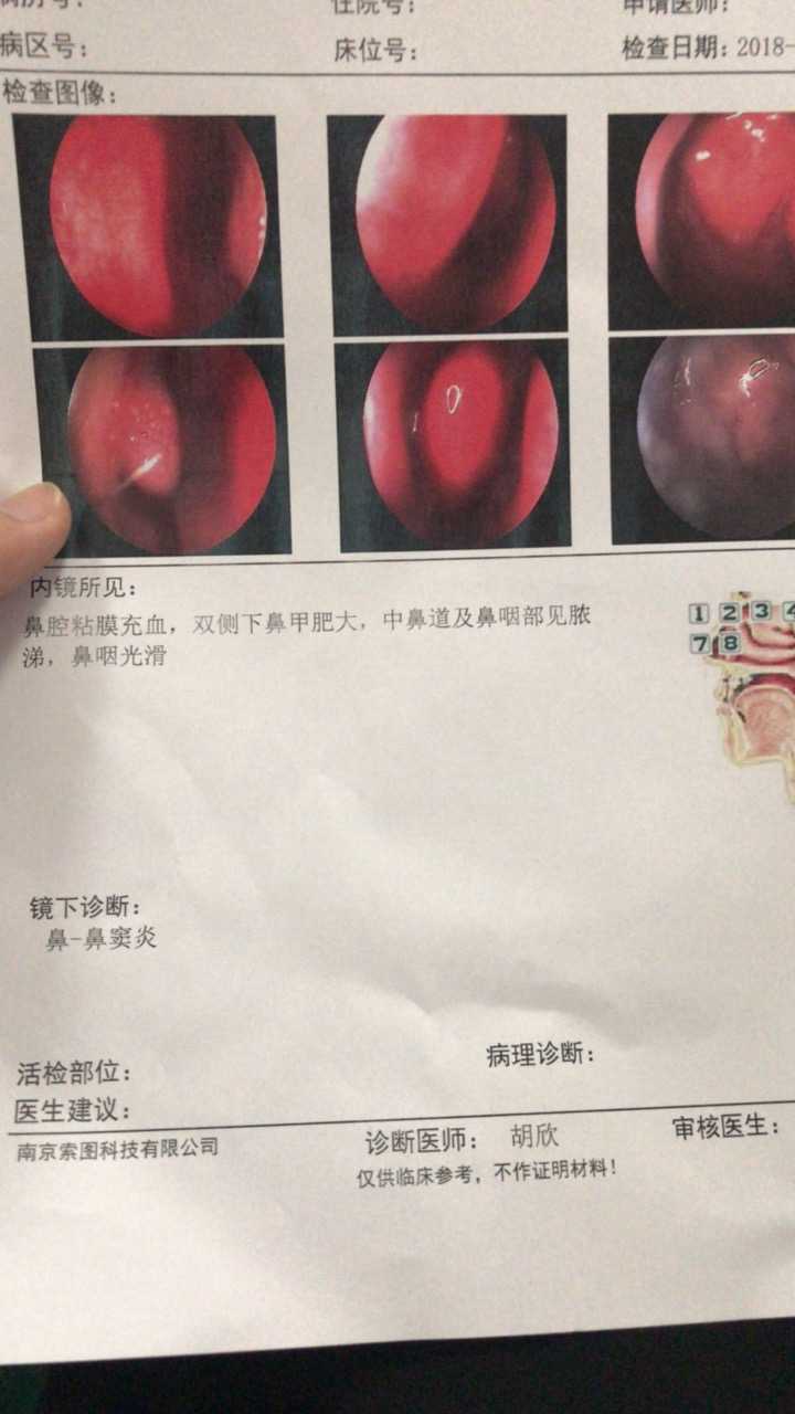 鼻窦炎真实图片