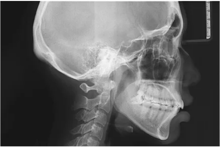 骨性龅牙x光片图片