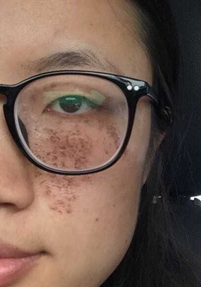 我脸上的雀斑样痣 只分布在左脸 去医院做过两次激光治疗 但一两年之后就恢复成原样 我还要继续在做吗 知乎 我脸上的雀斑样痣 只分布在左脸 去医院做过两次激光治疗 但一两年之后就恢复成原样 我还要继续在做吗 知乎