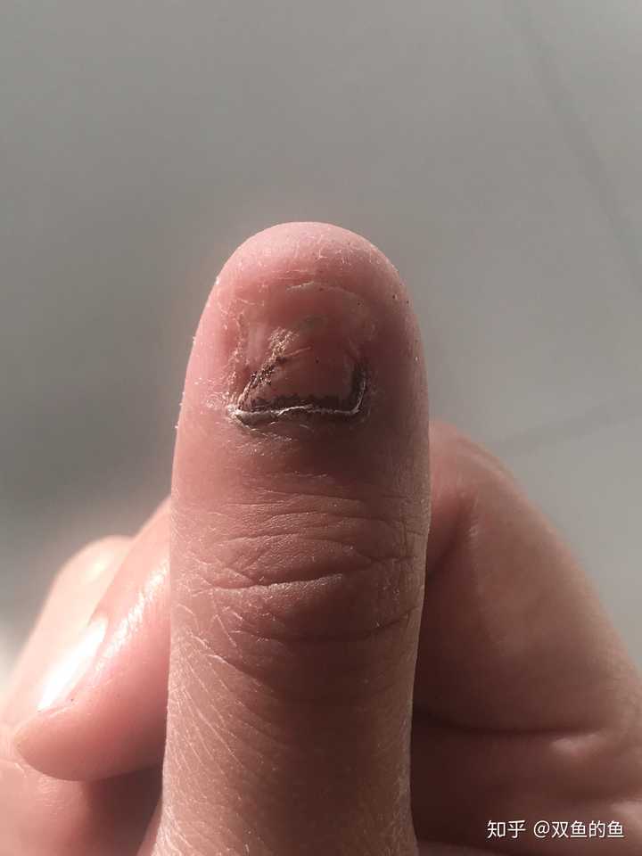 甲床受损长出的指甲图图片