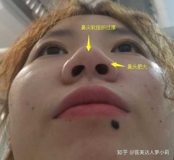 女生19歲,大鼻頭,鼻翼寬,蒜頭鼻,醫美手段具體應該怎麼做?