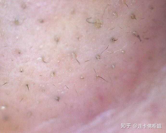 这种放大了看,黑头和黑毛粘在了一起