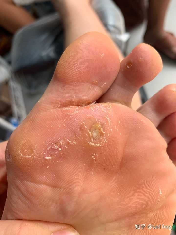 鸡眼怎么彻底挖出