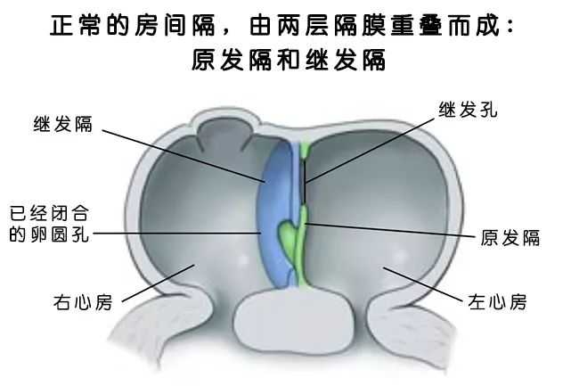 先心病房间隔缺损多大必须手术 知乎 先心病房间隔缺损多大必须手术 知乎