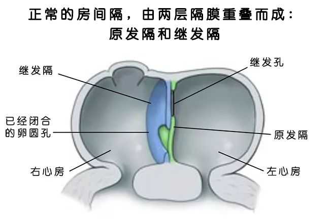 先心病房间隔缺损多大必须手术 知乎