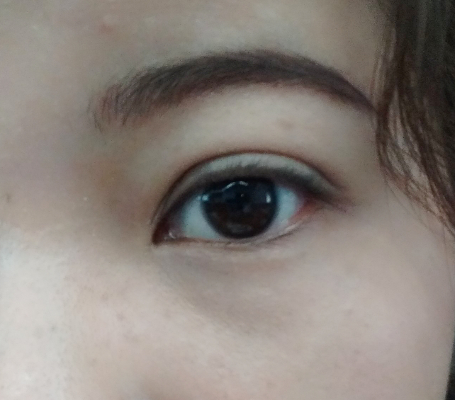 如何消除眼皮脂肪?