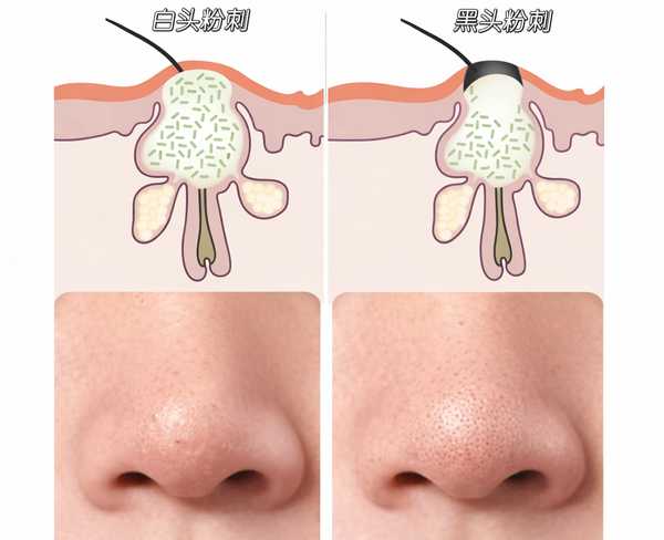 女子挤痘痘后确诊 2 型糖尿病，问题出在哪儿？挤痘痘还有哪些风险？