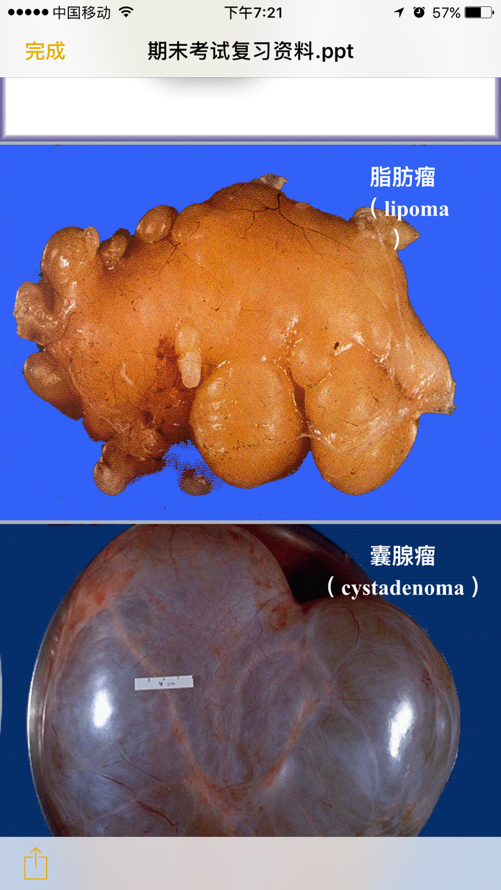 脂肪瘤的构造是什么?是液体吗?