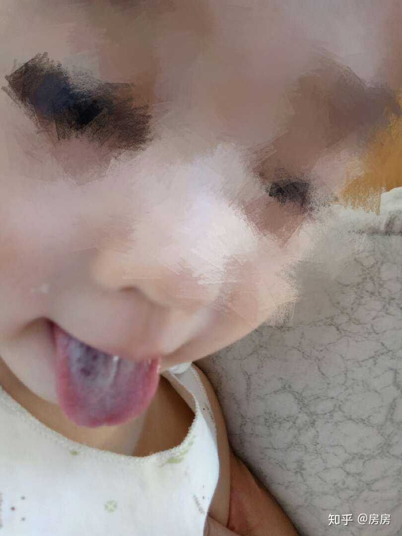 谁知道这种病,可能是舌面血管畸形想到北京看一下有没有推荐的医院和