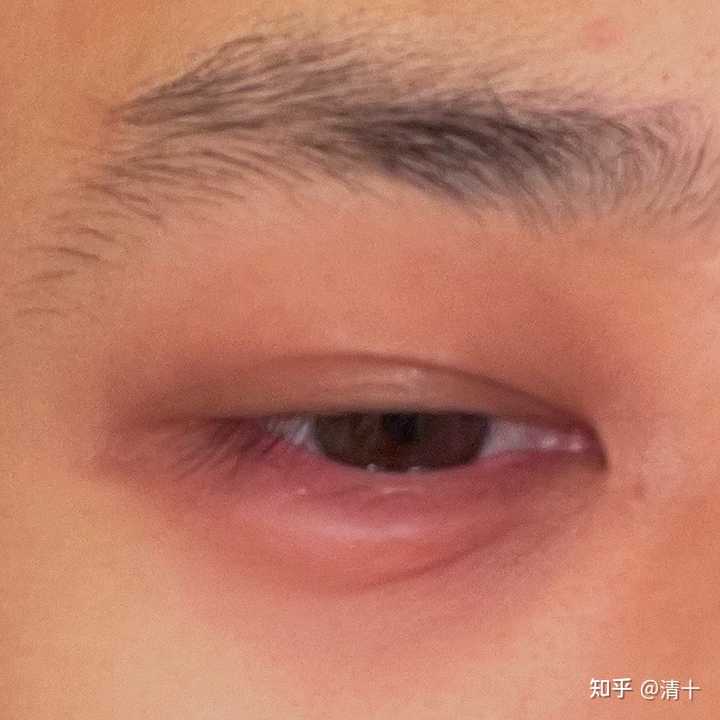 下眼袋突然肿起来是什么回事 知乎