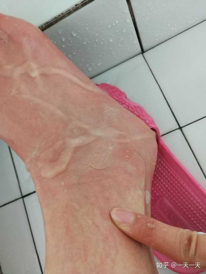烫伤前后皮肤的具体变化是怎样的 知乎 烫伤前后皮肤的具体变化是怎样的 知乎