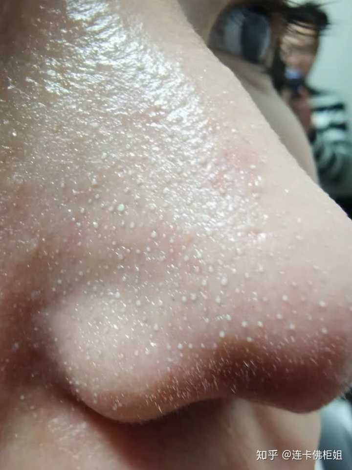 去黑头的最简便的方法?