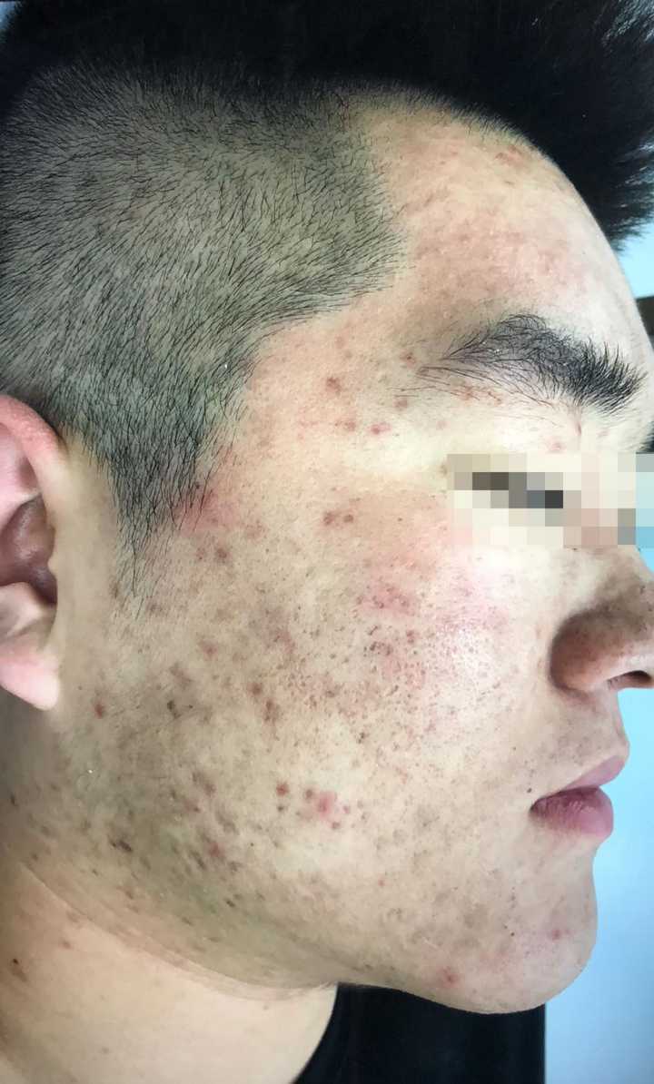 满脸痘坑的人都活得怎么样