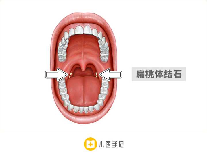 扁桃体结石是如何形成的 知乎