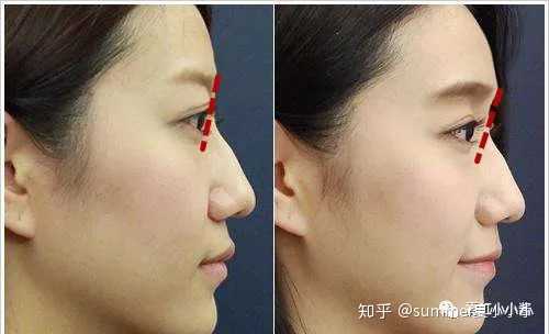 隆眉弓手术安全稳定吗 技术是不是没有隆鼻手术成熟 有什么副作用 Summer夏小小小的回答 知乎 隆眉弓手术安全稳定吗 技术是不是没有隆鼻手术成熟 有什么副作用 Summer夏小小小的回答 知乎