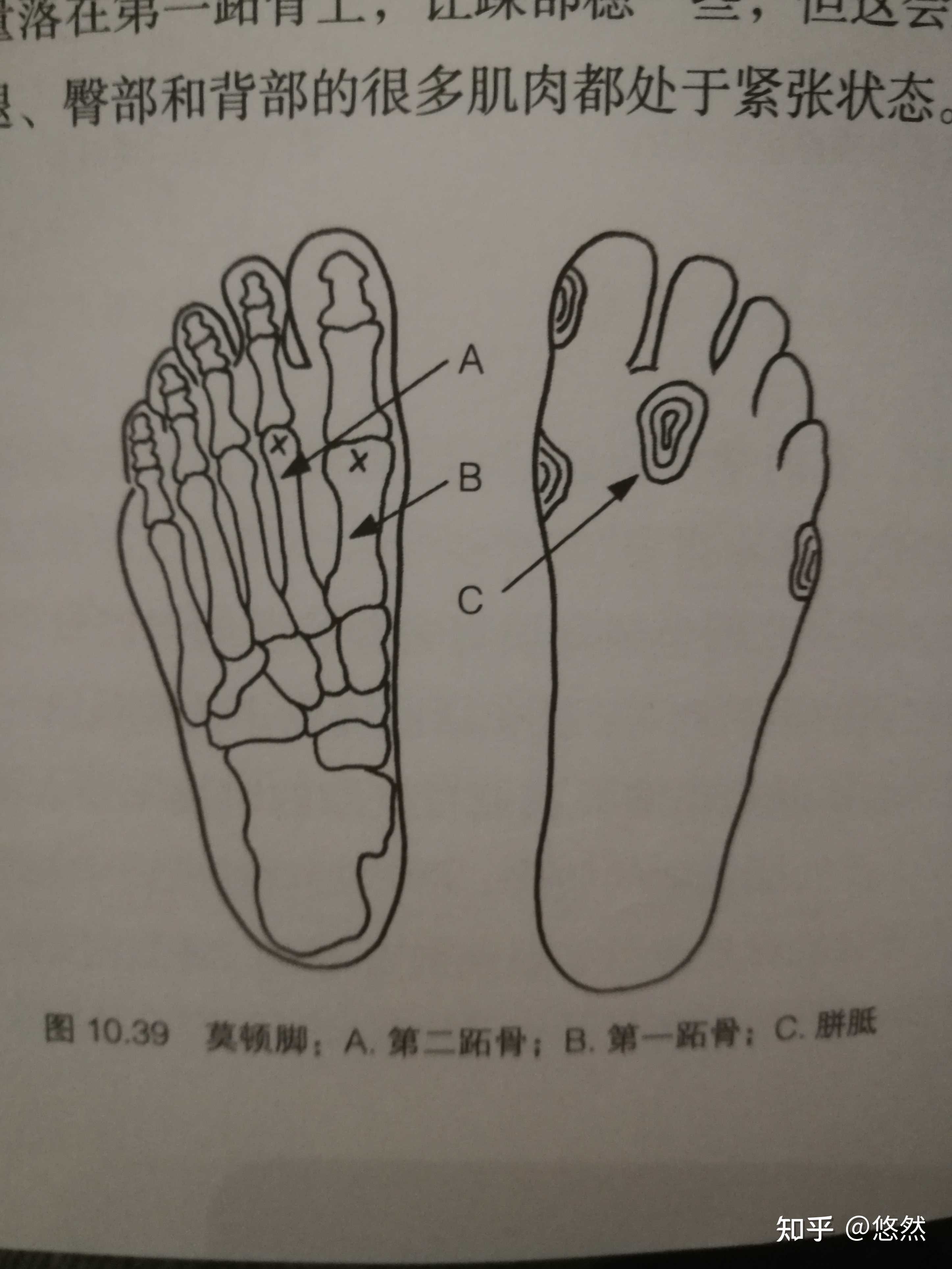 悠然 的想法: 松解拇长伸肌多日,大脚趾依然疼痛不止 - 知乎