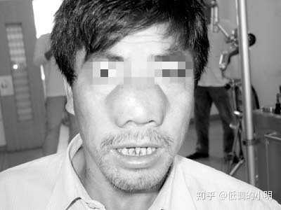 长了鼻息肉一定要切掉么?除了手术还有什么其