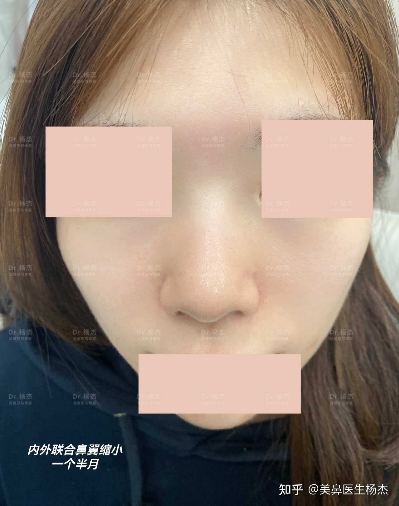 美鼻医生杨杰 的想法: 【内外联合鼻翼缩小 鼻槛上提】一个半月