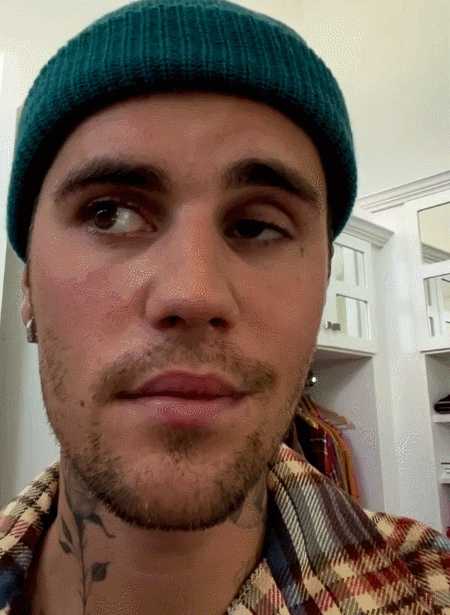 贾斯汀比伯患亨特氏综合征右脸面瘫引网友围观这病有多严重