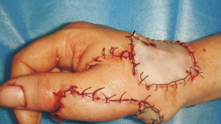 游离皮瓣移植,直接转移,通过血管吻合将皮瓣放在缺损等移植部永久存活