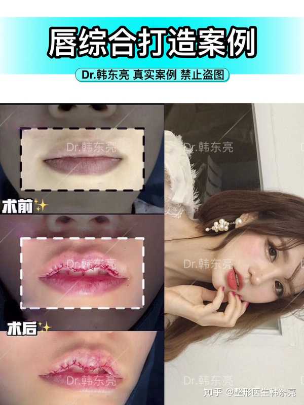 做完手术之后,立马就能看出大致的唇型调整效果,上唇适当改薄并呈m形