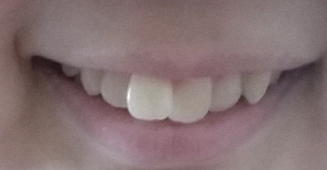 矫正牙齿\/正畸\/戴牙套需要拔几颗牙?