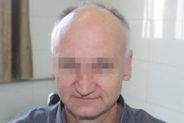 发际线额角以上以及头顶部位属于完全没有头发,大面积光裸u型脱发