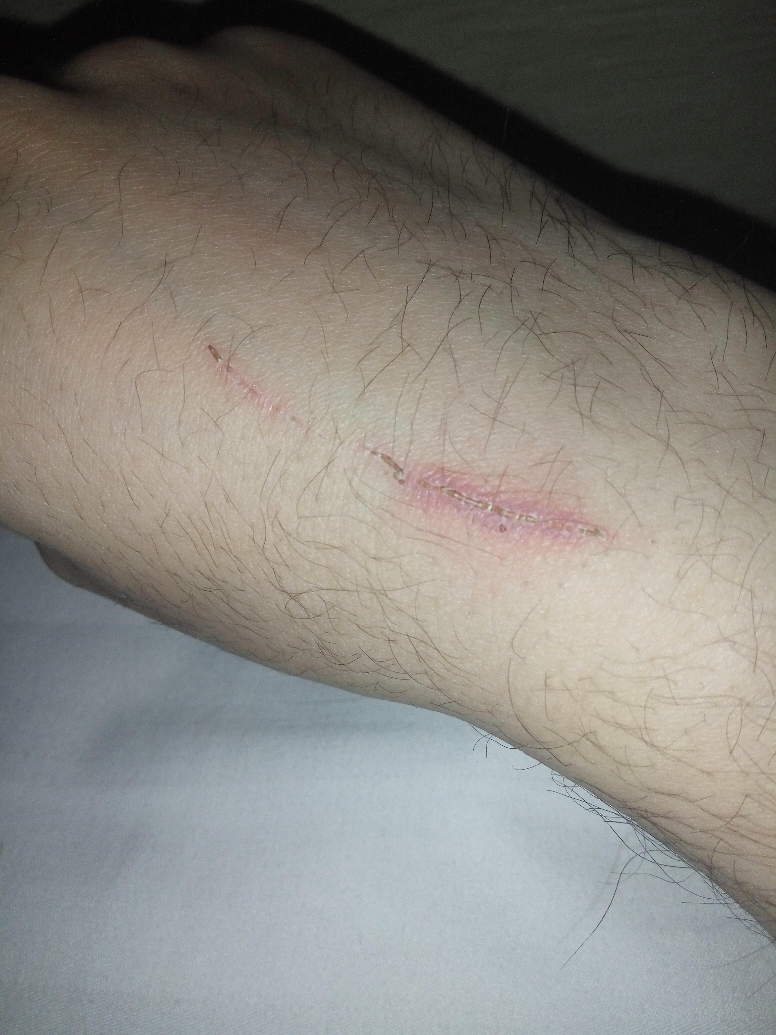 请问下我这种会得破伤风吗?