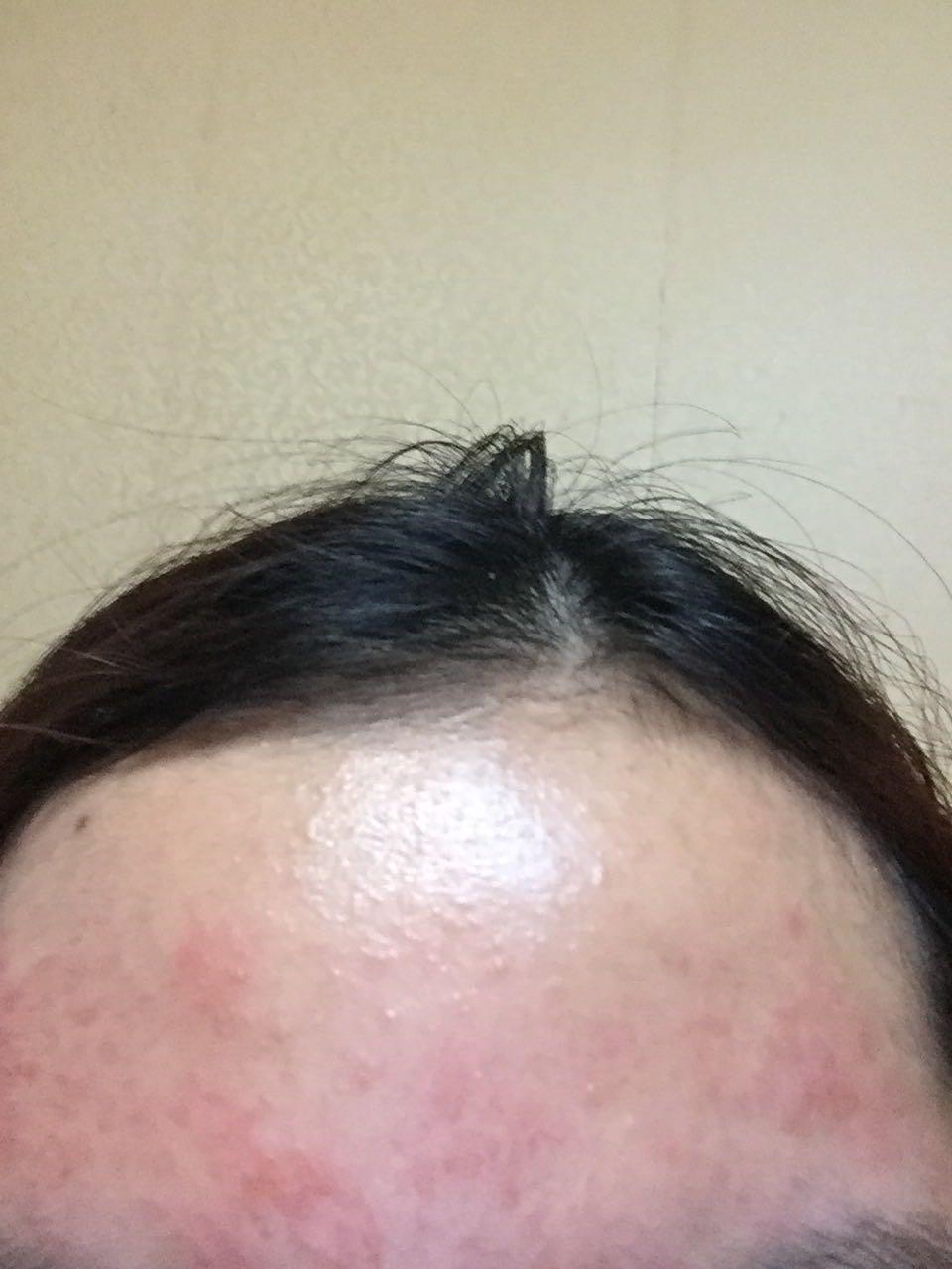 脸部过敏如何有效解决？ - 知乎