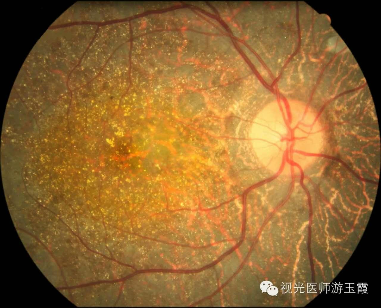 视网膜色素变性新突破图片