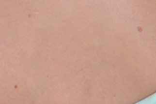 【人种差异?】白人妞身上的棕色斑点到底是什