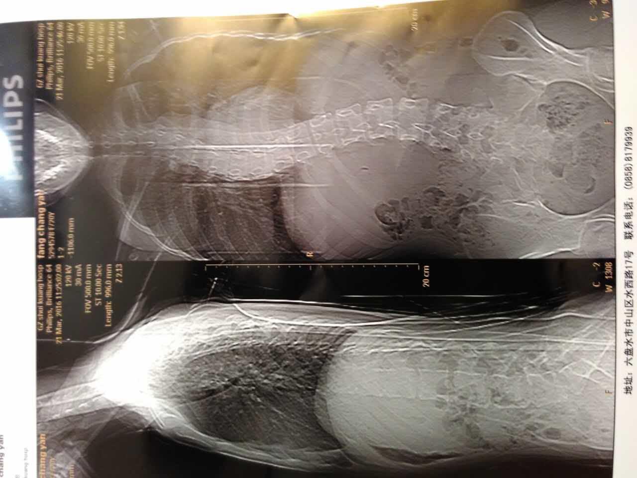 这样的脊椎弯曲严重吗?应该如何保守治疗? - 医疗