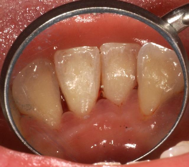 门牙内侧有尖刺一样的东西磨得舌头疼请问我应该怎么做