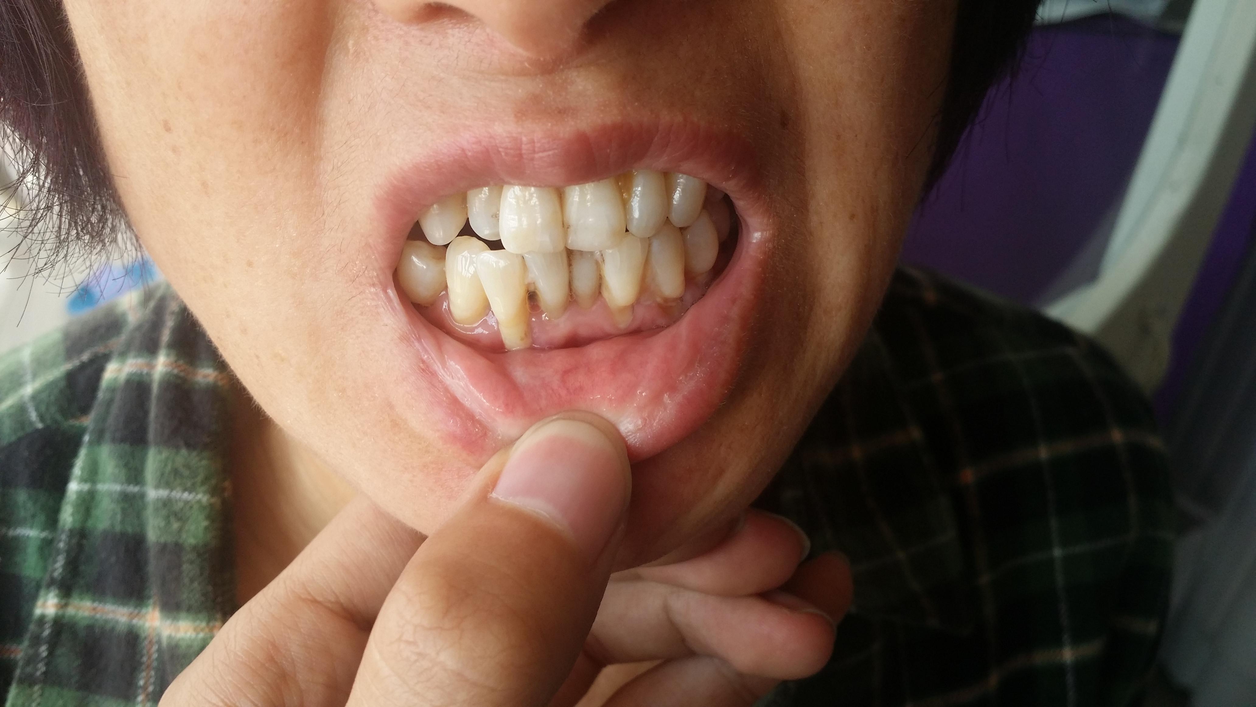 洗牙究竟是好是坏？牙医：牙齿健康除了洗牙，日常还要做好这些_口腔