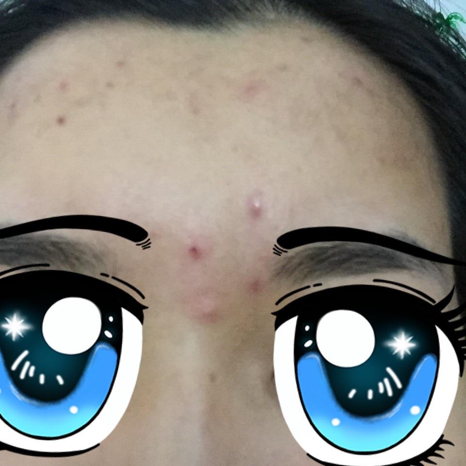 眉间长了两个大脓包怎么办 按下去会痛 也没有