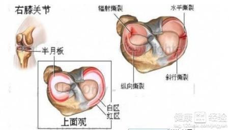 半月板损伤 知乎