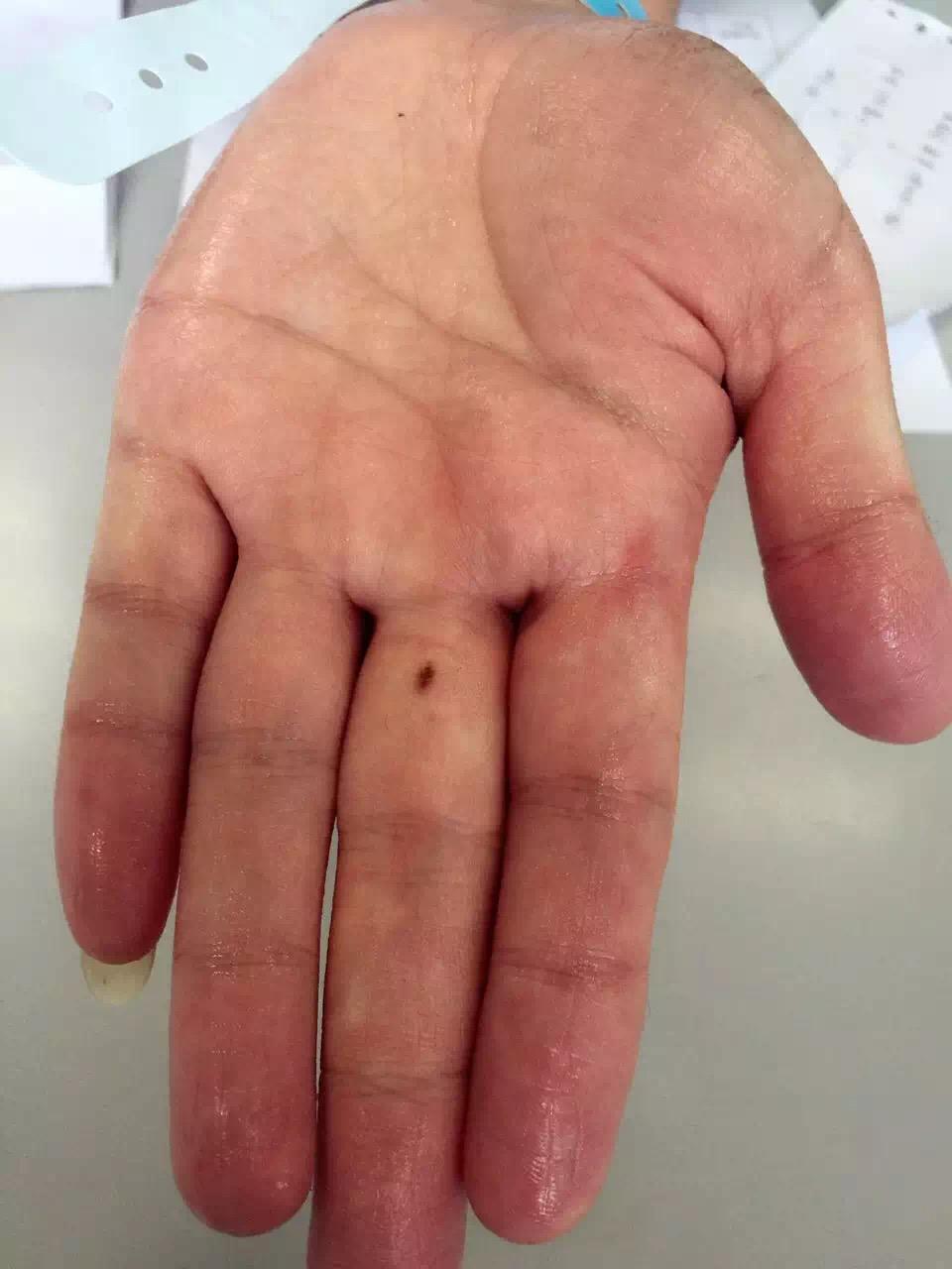 手脚很爱出汗怎么办,基本上就是握住拳头一会