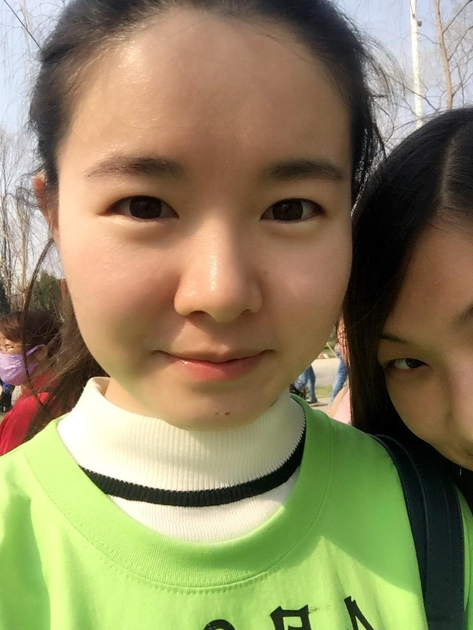 内双,感觉上眼皮脂肪有点厚,想割双眼皮,比较想