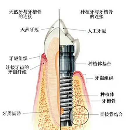 牙周病的治疗步骤