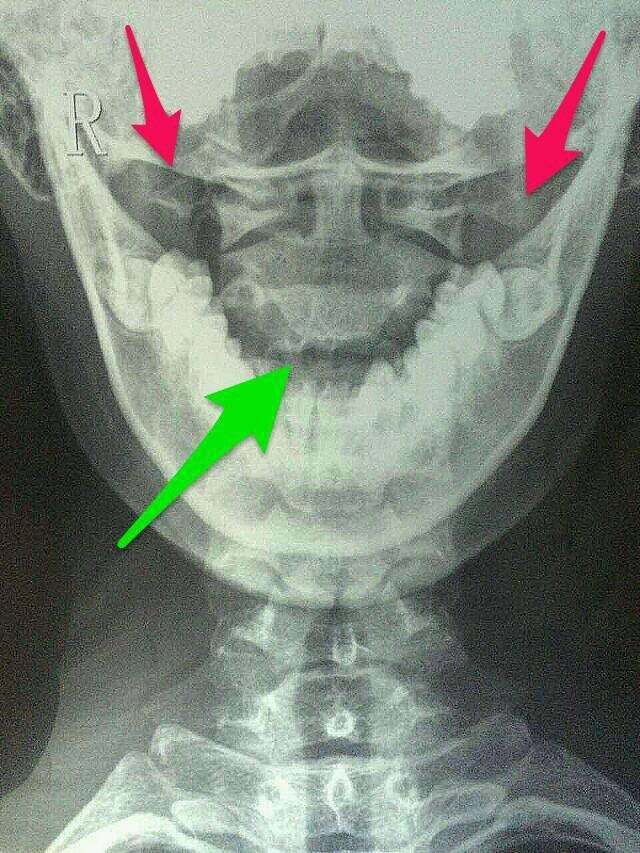 这是一个寰枢关节半脱位合并颈椎反弓