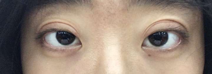 近视眼,眼球突出,一年前做了双眼皮.这样是不是失败了呀?