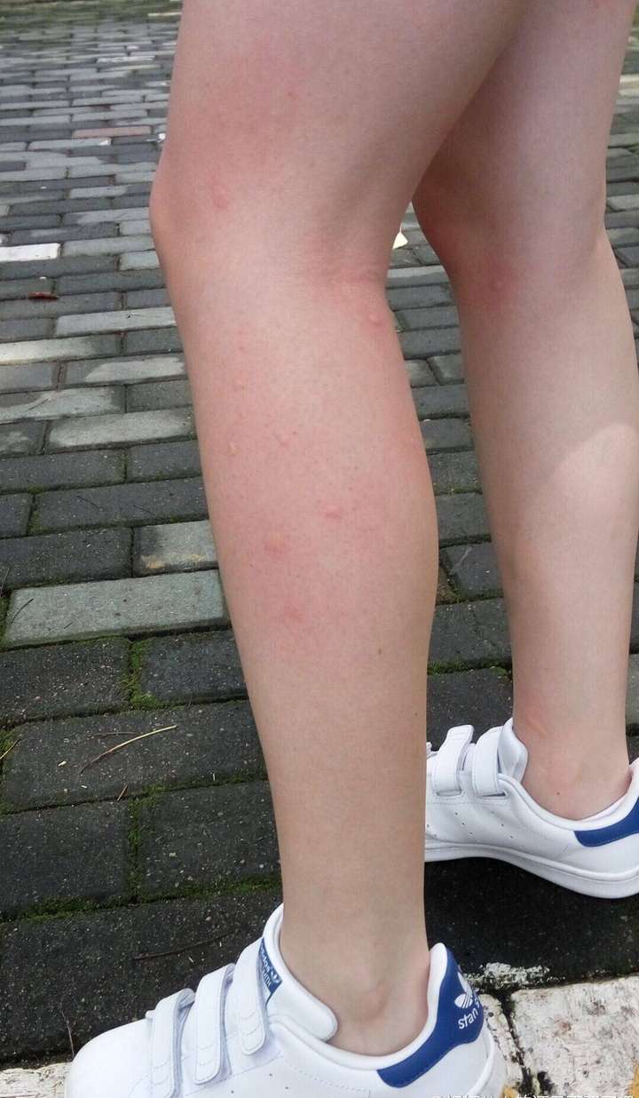被蚊子咬是怎么一番体验?