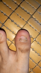 嵌甲,两脚大拇指嵌甲很深,每次剪指甲都要流血,有好办法吗?