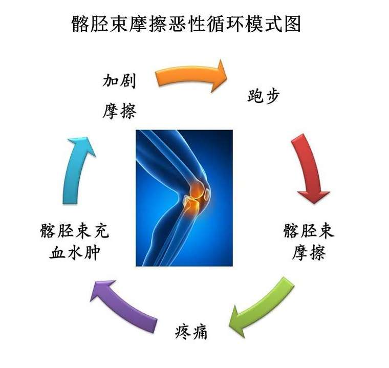 终结你的髂胫束综合症 不只是休息 知乎