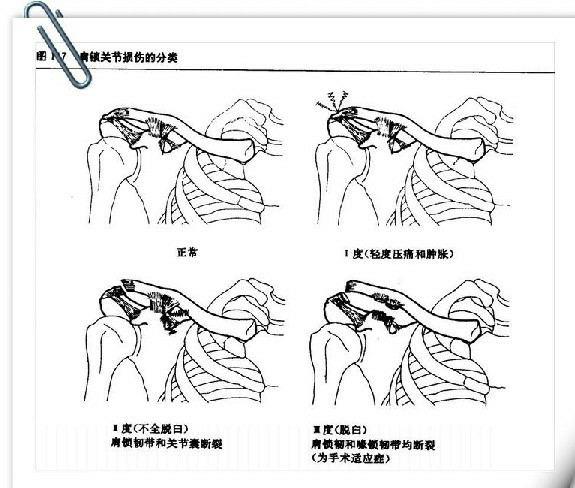 肩关节外旋复位法图解图片