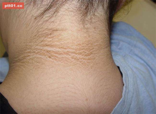 女性雄性激素过多,如何正确调理,以期取得长远效果?